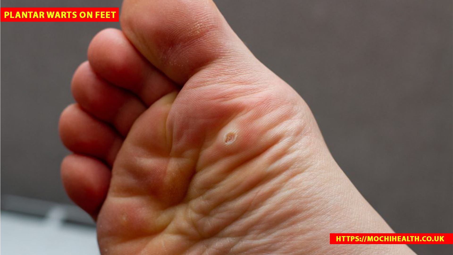 plantar warts on feet