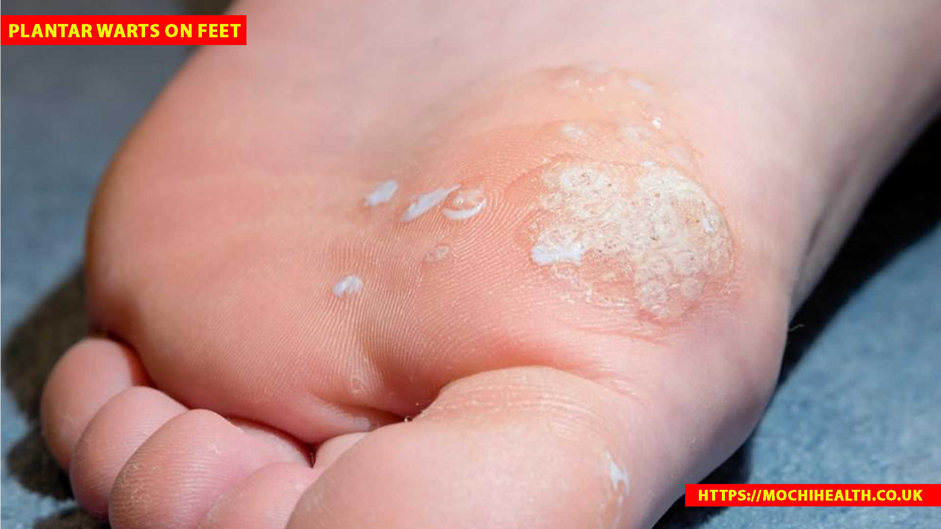 plantar warts on feet