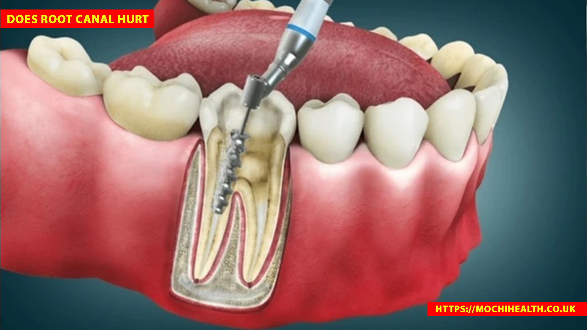 does root canal hurt
