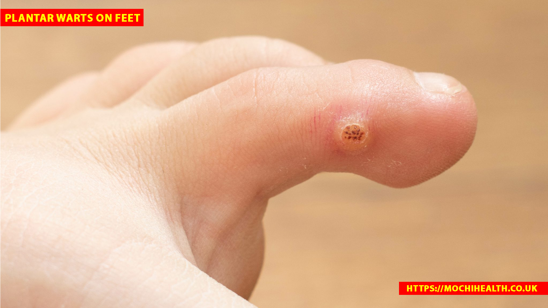 plantar warts on feet