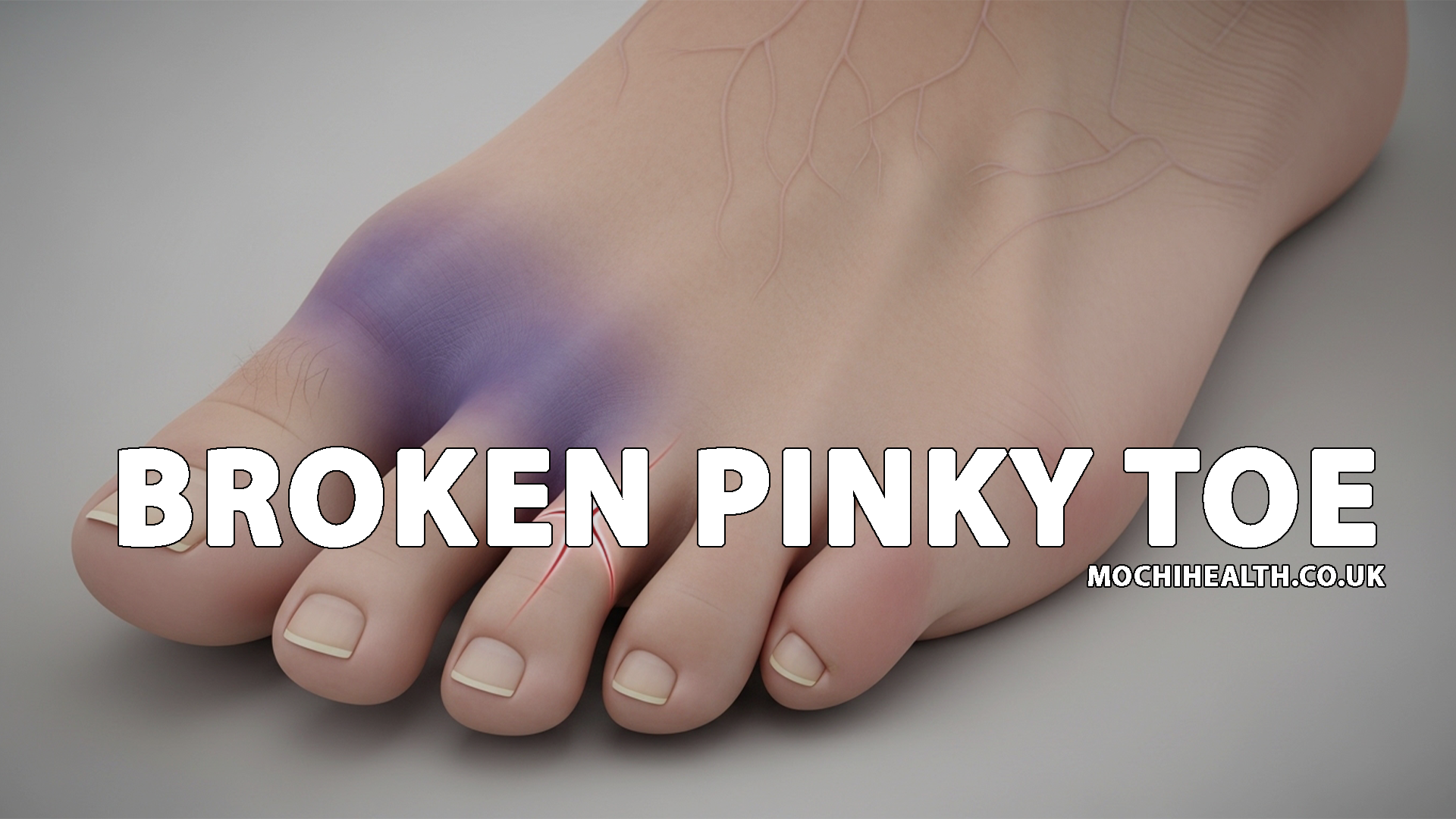 broken pinky toe